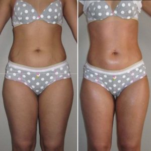 bioslimming body wrap before and after