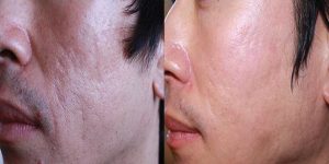 Microneedling for acne scars