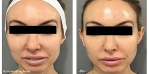 young woman face before and after microneedling